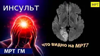Ischemic stroke due to vertebral artery dissection.