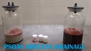 Psoas abscess