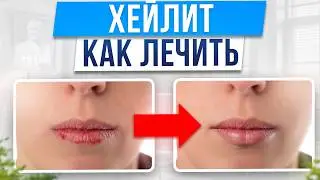 Почему губы ТРЕСКАЮТСЯ и ШЕЛУШАТСЯ? / Причины и лечение сухости губ