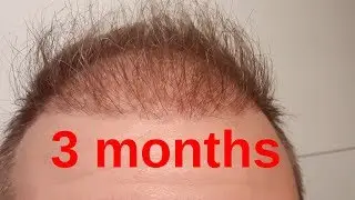 hair transplant istanbul turkey 3 months update 13 weeks