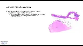 Ganglioneuroma (peri-adrenal fat) Microscopy - Talking slide