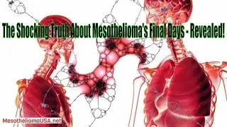 Final Days Of Mesothelioma - Final Days