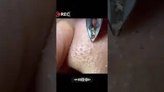 🤔 Забитые поры на носу #3