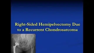 Hemipelvectomy Due to Recurrent Chondrosarcoma