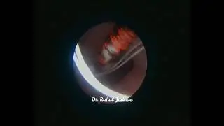 Hysteroscopic Cu T removal