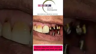 Missing Teeth Smile Makeover: Dental Implants and CAD CAM Bridge #smilemakeover