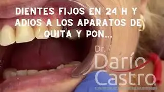 TENER DIENTES FIJOS EN TAN SOLO 24 HORAS Y DECIR ADIOS A LOS APARATOS DE QUITA Y PON…!!