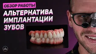 Альтернатива имплантации зубов. Обзор работы