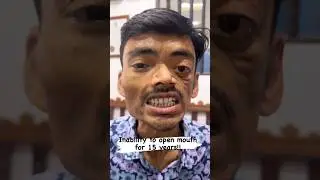 Fixing Zero Mouth opening
