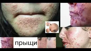 КАК ИЗБАВИТЬСЯ ОТ ПРЫЩЕЙ РАЗ И НАВСЕГДА!!!