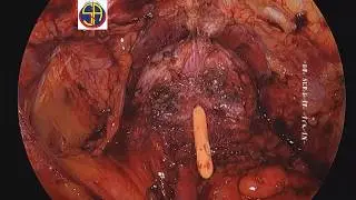 SA-38 Laparoscopic Radical Prostatectomy - nerve sparing (full-no editing)-5 . SERDAR AYKAN, MD