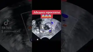 Абсцесс простаты 