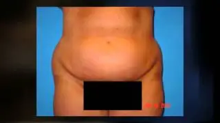 Michigan Plastic Surgeon - Dr John Sampson