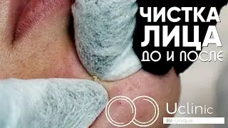 Facial Cleansing | Showing the Procedure | Before and After