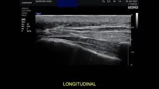 Ultrasound guided caudal epidural injection.