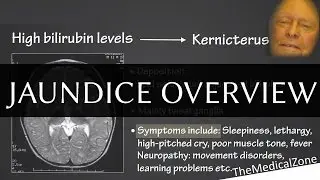 Jaundice Overview - Definition and Pathology (Including neonatal jaundice)