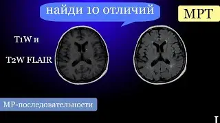 Basic Lectures on MRI/MR Sequences: The Difference Between T1W and T2W FLAIR Images