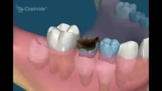 Сохранение места после удаления молочного зуба
