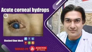 Acute corneal hydrops