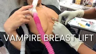 Vampire Breast Lift Treatment | Infinity MedSpa