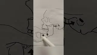 How to make reduction of the dislocated Tempromandibular joint