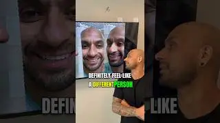 Wide Nose! | Hispanic Male  Rhinoplasty! | Before + After !