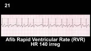ECG Rhythm Recognition Practice - Test 1