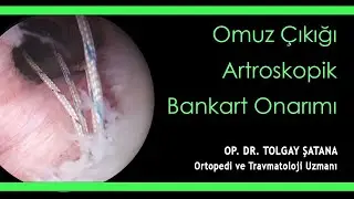 Omuz Çıkığı Artroskopik Bankart Onarımı