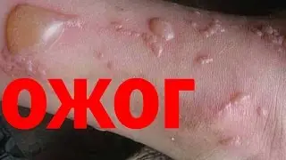 Ожог Обжегся Что Делать при Ожоге ШОК