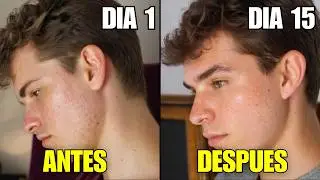Esto te Quitara las Manchas de Acné (solución fácil)