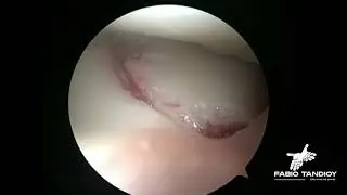 Manejo artroscópico de lesión lunotriquetral