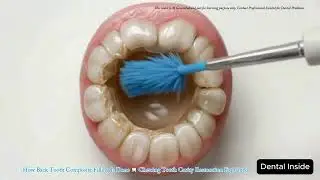 How Back Tooth Composite Filling Is Done 🦷 Chewing Tooth Cavity Restoration Explained | 3D Education
