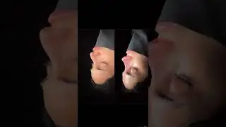Third Revision Rhinoplasty for Barbie Nose: Before and After