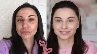 How to Get Rid of Age Spots Permanently / My Experience with Treatments Inside and Out