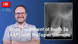 🔴 Endo Treatment of tooth 26 (AAP) with ProTaper Ultimate