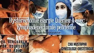 Hystérectomie élargie Querleu A avec curage ilio-obturateur ( ADK de l'endomètre stade IB)