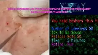 BLACKHEADS EXTRACTIONS vs VIDEOGAMES - Social Experiment