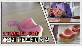 💥총의치 개인트레이 제작~ 👍 완벽해 !! 이제 남은건 정밀인상채득