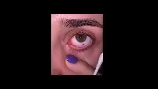 Giant Blackhead and Pimple Popping Removal compilation