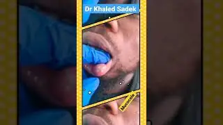 lip cysts are found on the inside smooth mucosa. Dr Khaled Sadek.