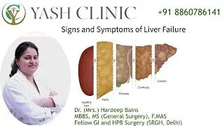 Signs and Symptoms of Liver Failure. 4 Signs your liver is damaged - Dr. Hardeep Bains