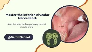 Mastering the Inferior Alveolar Nerve Block – Made Simple