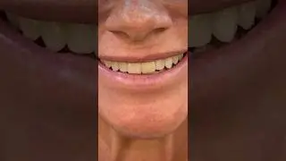 I love it when patients opt for a natural look  # #veneers #dentist