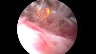 agresivní angiomyxom