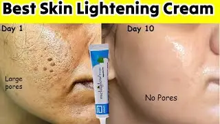 Melaglow Prime Depigmenting Cream Review: Does It Really Work? Best skin lightening cream in india|