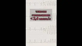 #гипокалиемия  #ecg #экг #ekg