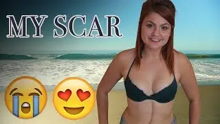 How to Get Rid of Scars Fast, Best Scar Treatment, How to Get Rid of Scar Spot Tissue on Face & Legs