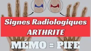 Mémo : Signes radiologiques de l’Arthrite