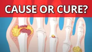 Fewer KIDNEY STONES and GOUT flare-ups on KETO