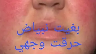 حروق الوجه عند العلاج من التصبغات الجلدية،ما الحل؟